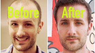 Hair Transplant Results -  True Stories