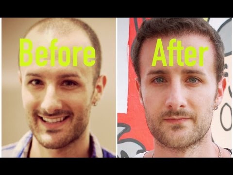 Hair Transplant Results -  True Stories