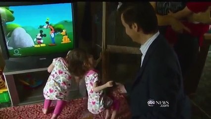 Conjoined Twin Girls Craniopagus sharing their brain