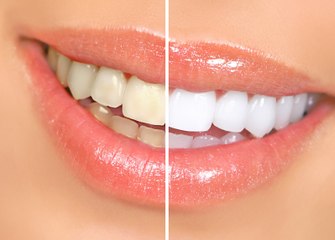 Home Remedies for Yellow Teeth - Get Shiny White Teeth HINDI URDU