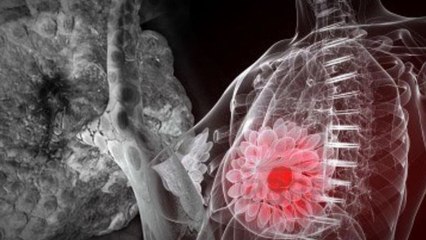 Yuk, Kenali Resiko Kanker Payudara