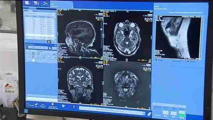 Un nuevo tratamiento elimina el temblor esencial sin cirugía intracraneal