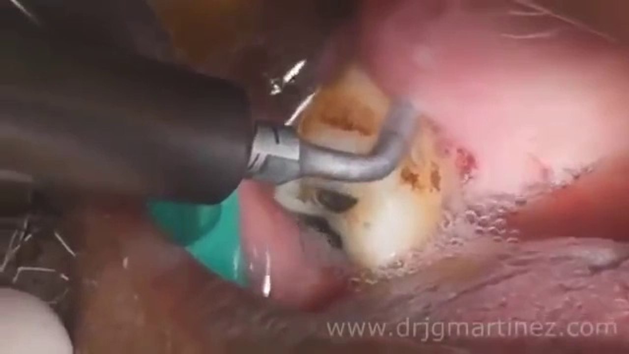 Tooth abscess extraction procedure