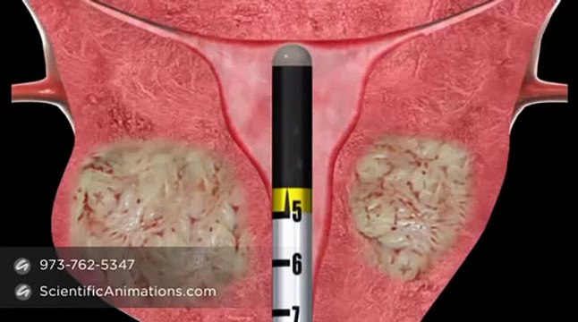 Femwave Endometrial Ablation Microsulis