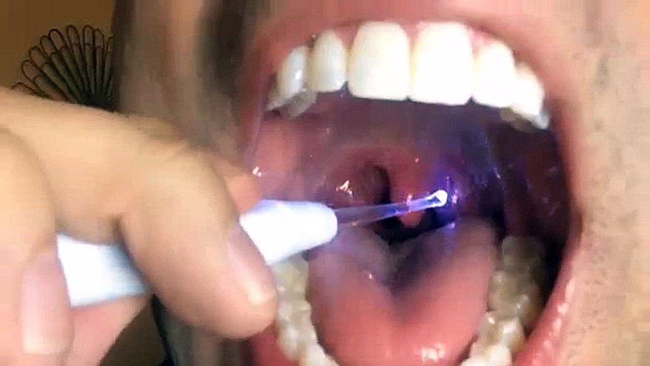 Extreme Tonsil Stone Removal [medical videos ]