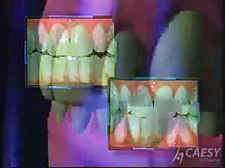 How make Teeth Whitening