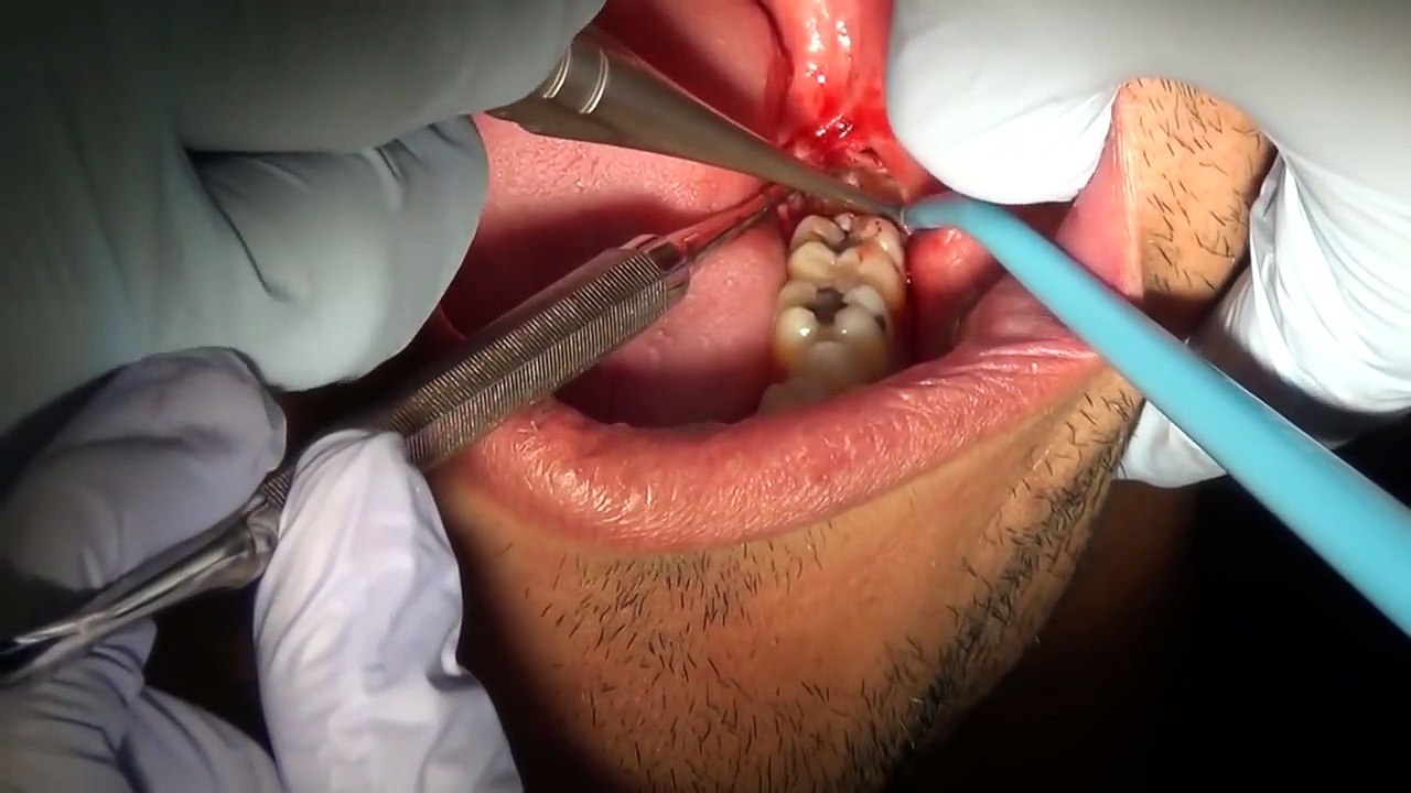 how to pull wisdom tooth Part 1 [ medical social ]