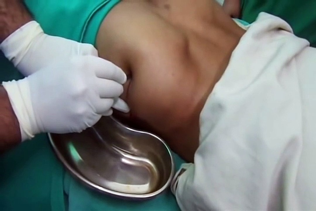 Incision and Drainage of a Huge Abscess [ Medical Social ]