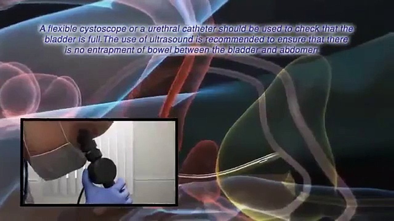 Mediplus Ltd S Cath TM A safer method of inserting a Foley catheter suprapubically