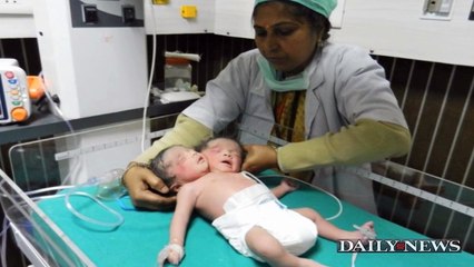 Two-headed Baby Girl Born in Bangladesh