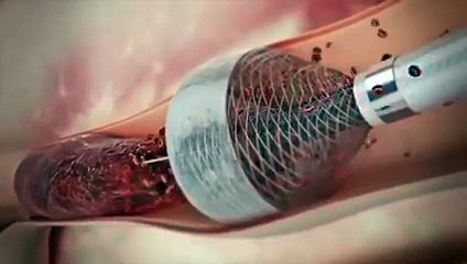 Treating blocked veins