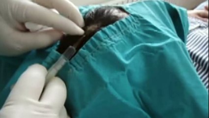 Kafada Yağ Bezesi Tedavisi Nasıl Yapılır?