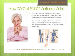 How to Get Rid of Varicose Veins