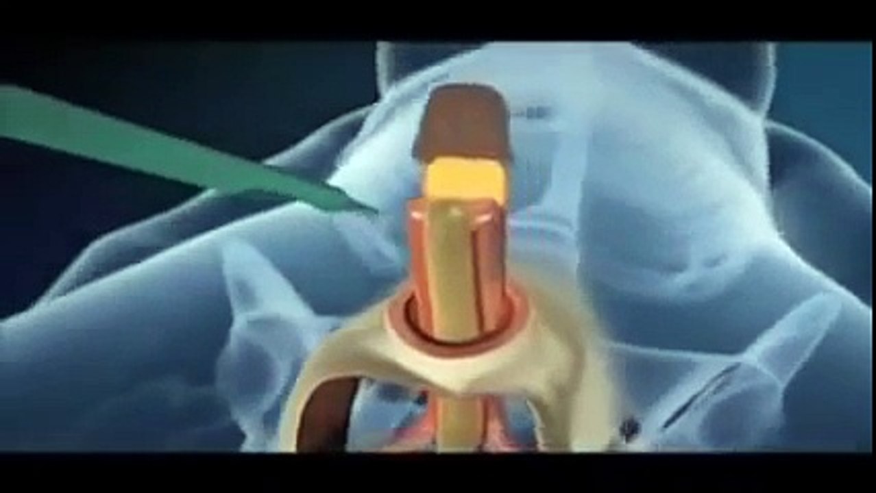 Imitation of surgery from male to female transsexuals