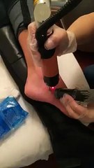 What is best laser to removeTattoo?  - Clarity Medspa Toronto