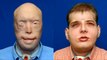 Американцы произвели самую сложную пересадку лица в мире/Firefighter gets world's most extensive face transplant