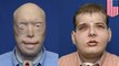 Disfigured firefighter gets world's most extensive face transplant