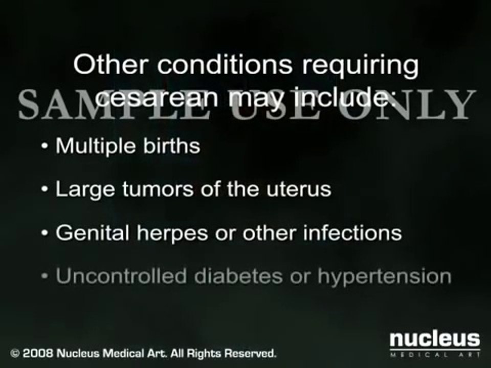 c section cesarean section delivery information for pregnant women