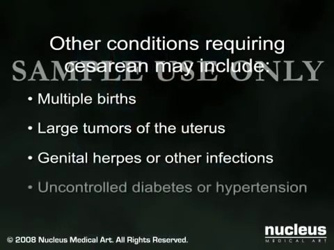 c section cesarean section delivery information for pregnant women