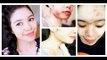 My Acne Story- How I Cured My Hormonal Acne and Rosacea-Diet -Skin Care and Encouragement