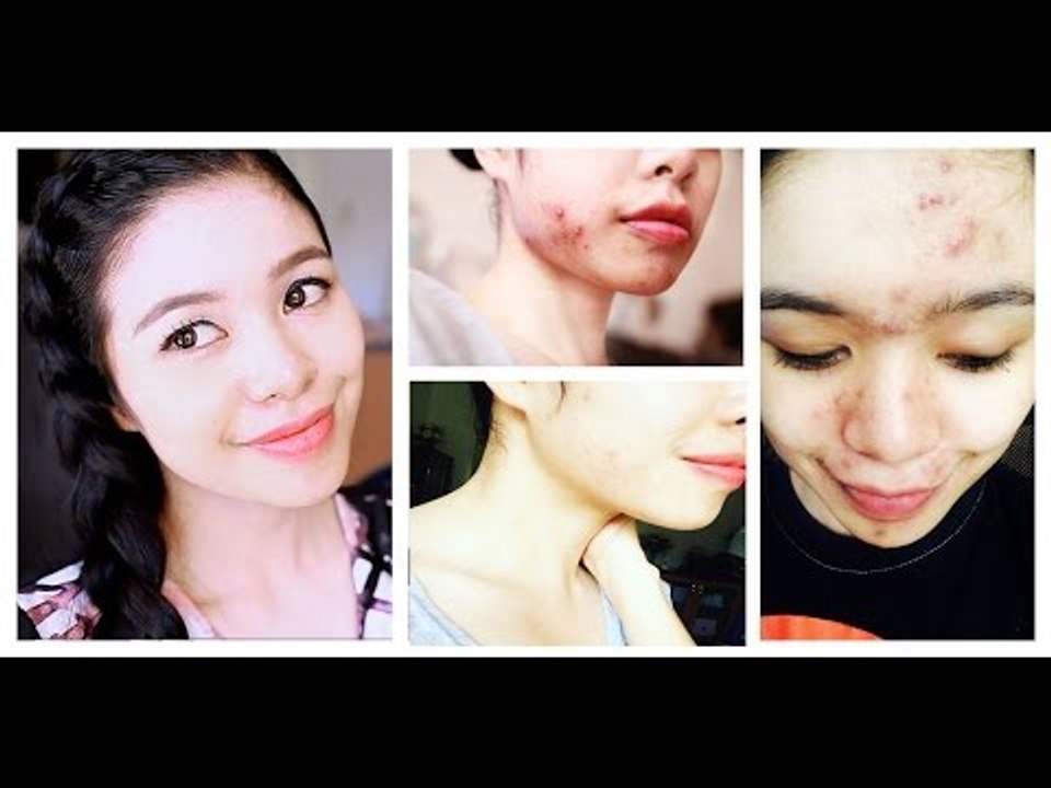 My Acne Story- How I Cured My Hormonal Acne and Rosacea-Diet -Skin Care and Encouragement