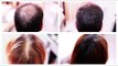 How to Cover Up Hair Loss, Bald Spots, Thinning Hair, Receding Hairline Effectively- A MUST SEE