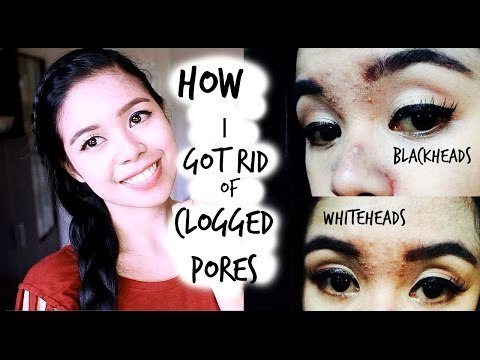 How I Got Rid of my Clogged Pores, Black Heads, White Heads on Forehead and Nose Plus SkinCare