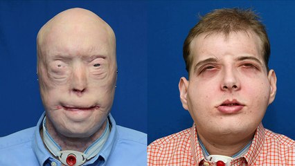 US team carries out most complex face transplant