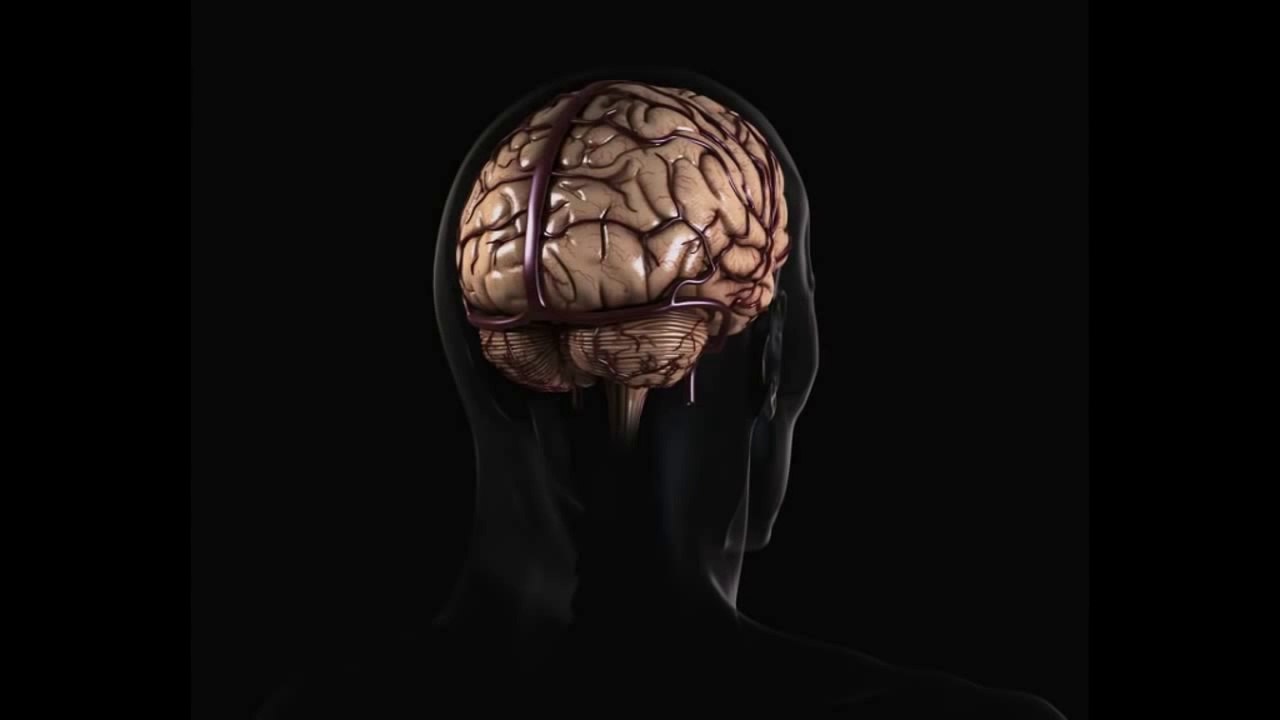 Pineal cyst