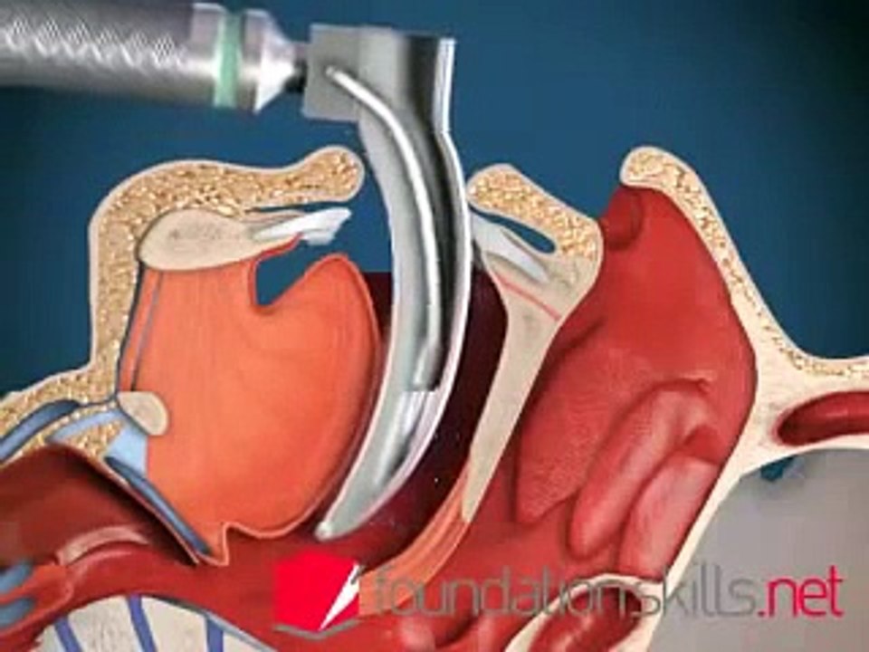 ENDOTRACHEAL INTUBATION PROCEDURE EXPLAINED video Dailymotion