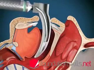 ENDOTRACHEAL INTUBATION PROCEDURE EXPLAINED