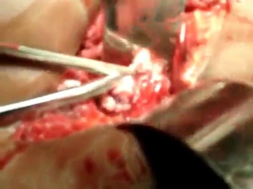 Total Laparoscopic Hysterectomy Easy stepsTLH dr abdul vahab