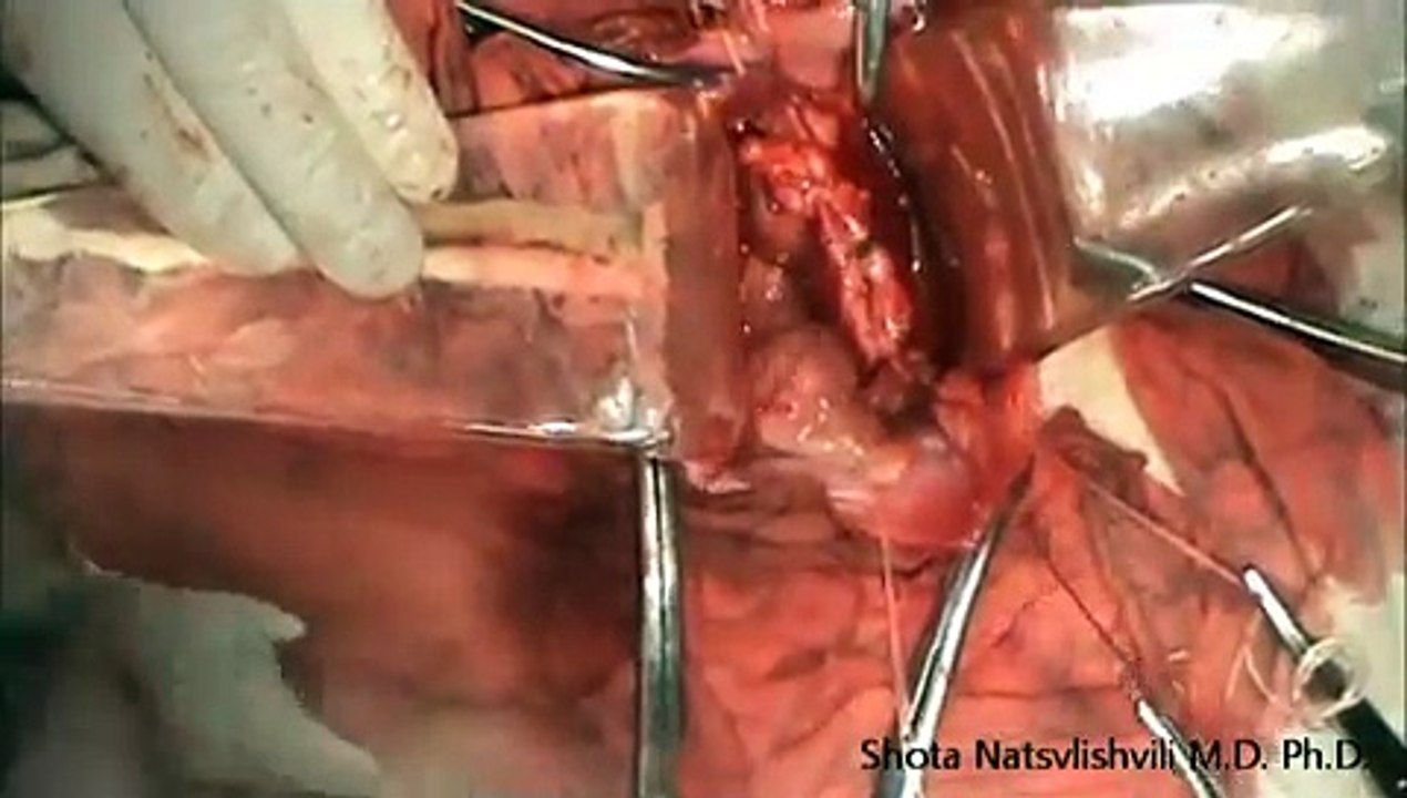 Total Abdominal Hysterectomy. Uterine fibroids