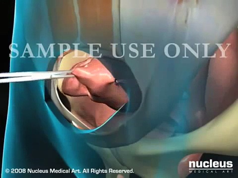Total Abdominal Hysterectomy: Incision and opening of the pelvic cavity
