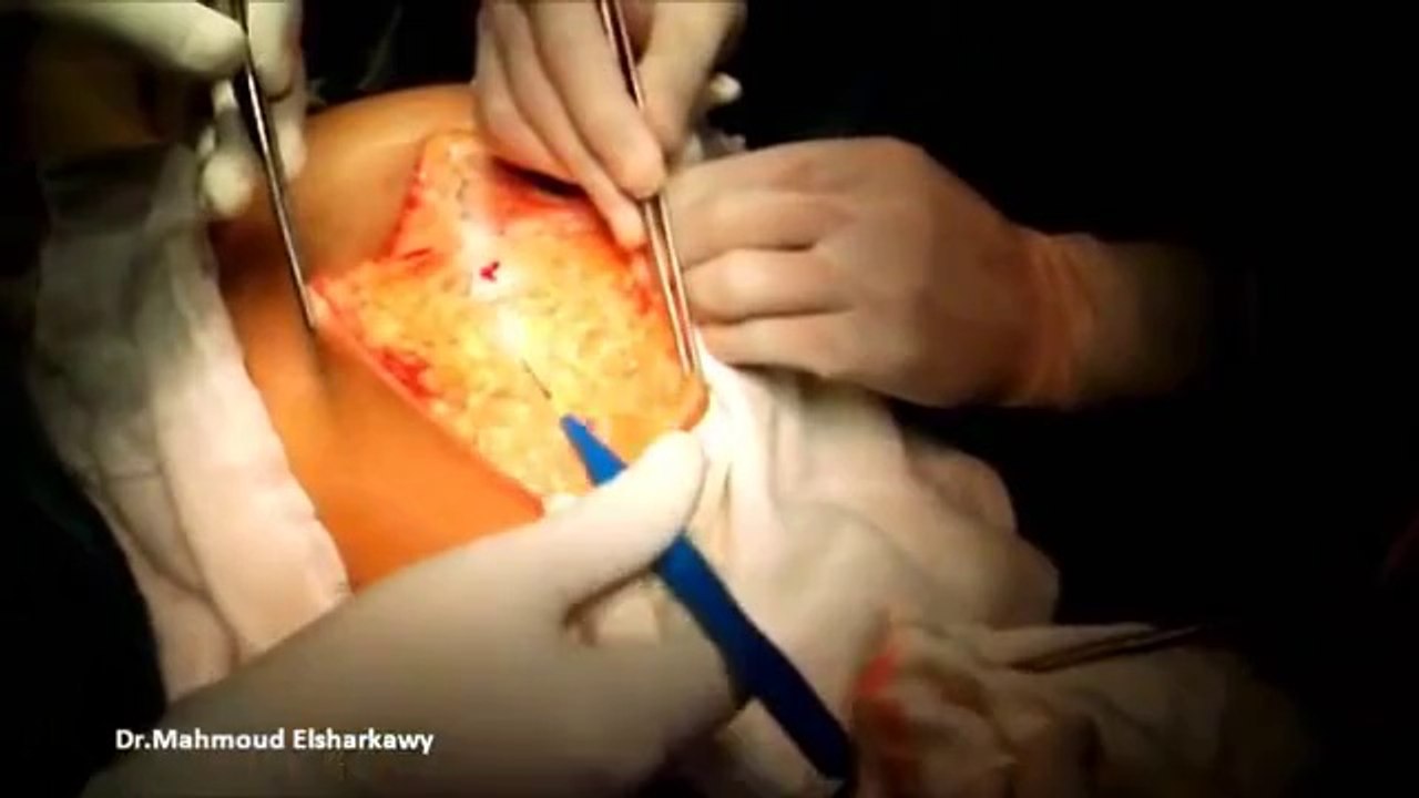 Total Abdominal Hysterectomy