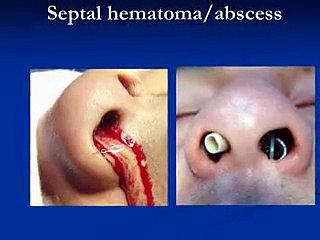 ENT Emergencies (Nose) by Dr Meena Nihalani ( ENT Specialist in Indirapuram)