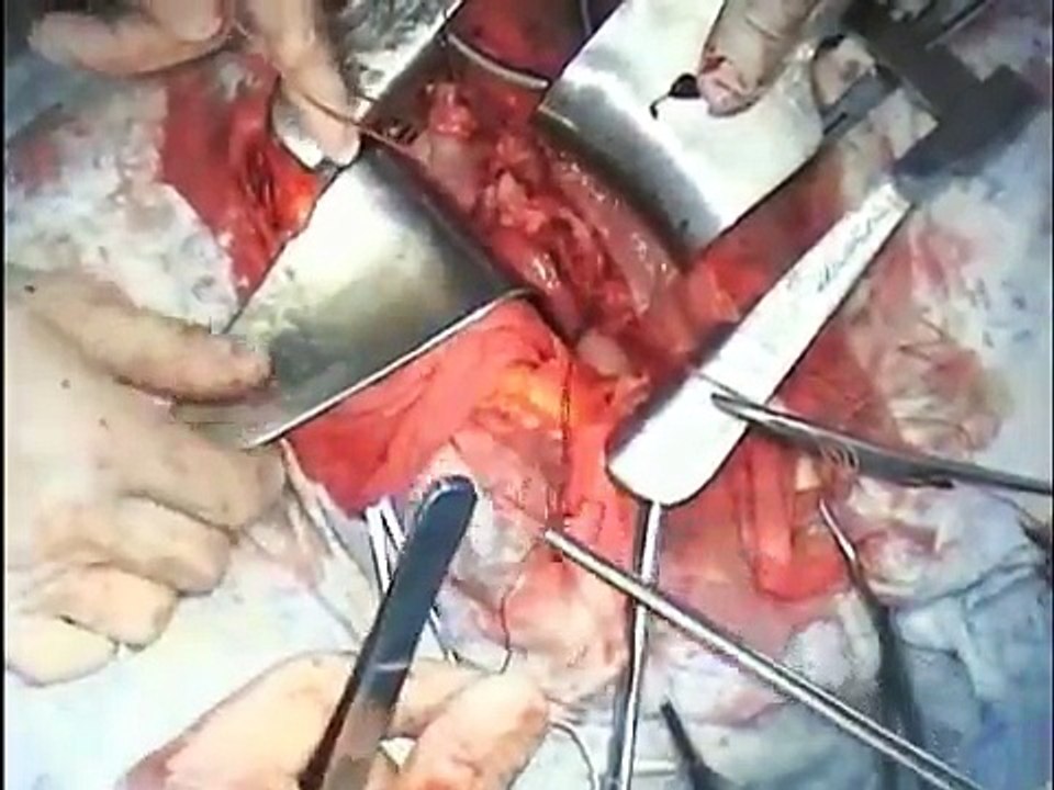 Total Abdominal Hysterectomy. Uterine Fibroids