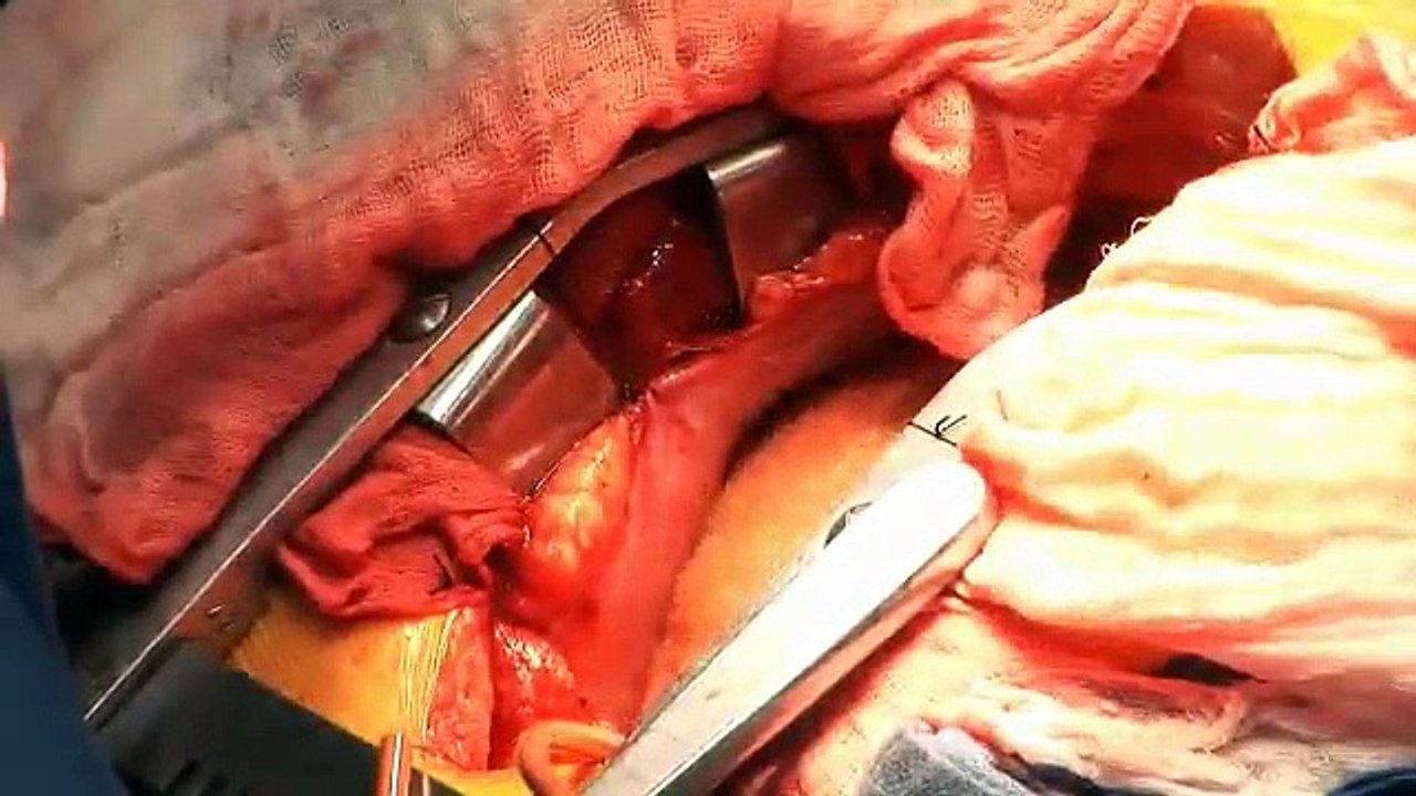 open heart surgery video procedure explained