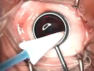 The management of cornea blindness from severe corneal scarring - Video abstract: 27175