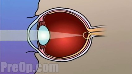 Laser Eye Surgery PRK PreOp® Patient Engagement and Education