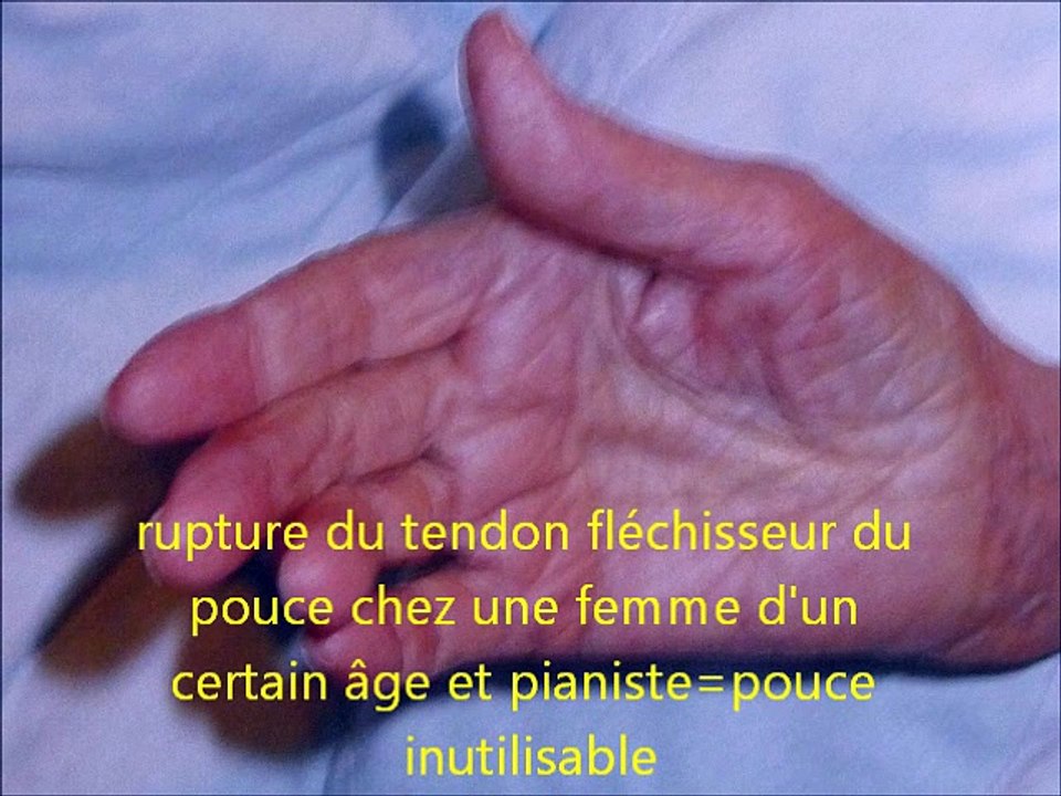 greffe tendon flechisseur ,par vladimir mitz