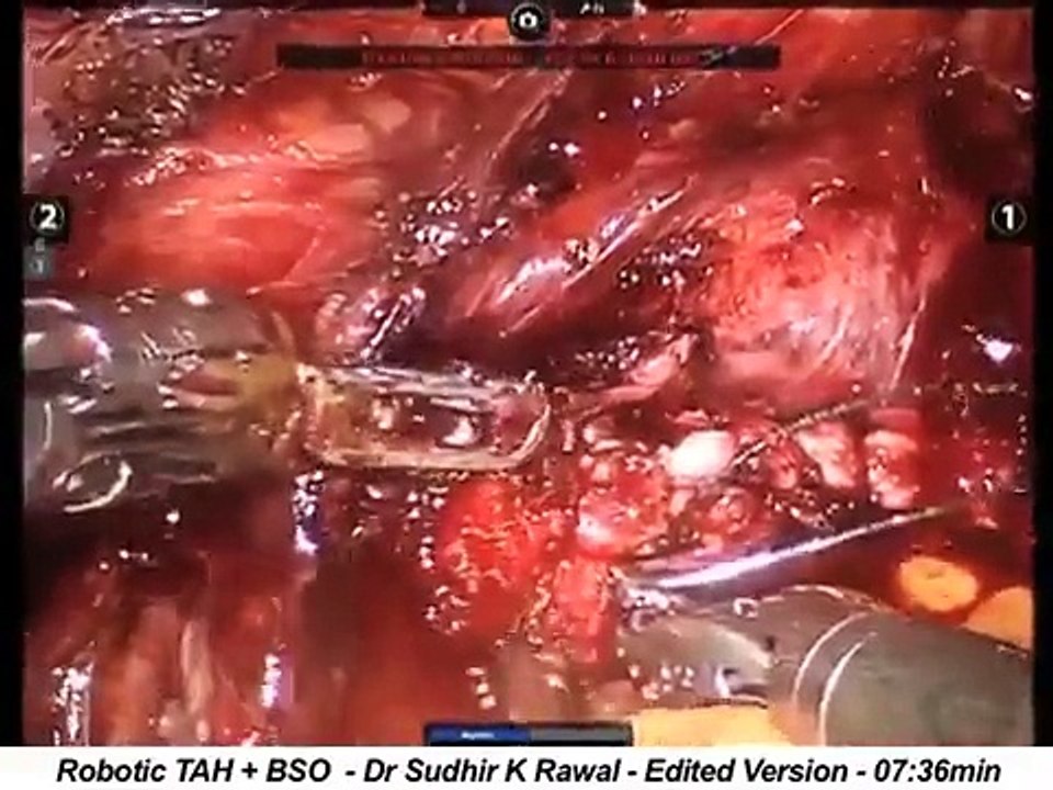Total laparoscopic hysterectomy + bilateral salpingo-oophorectomy