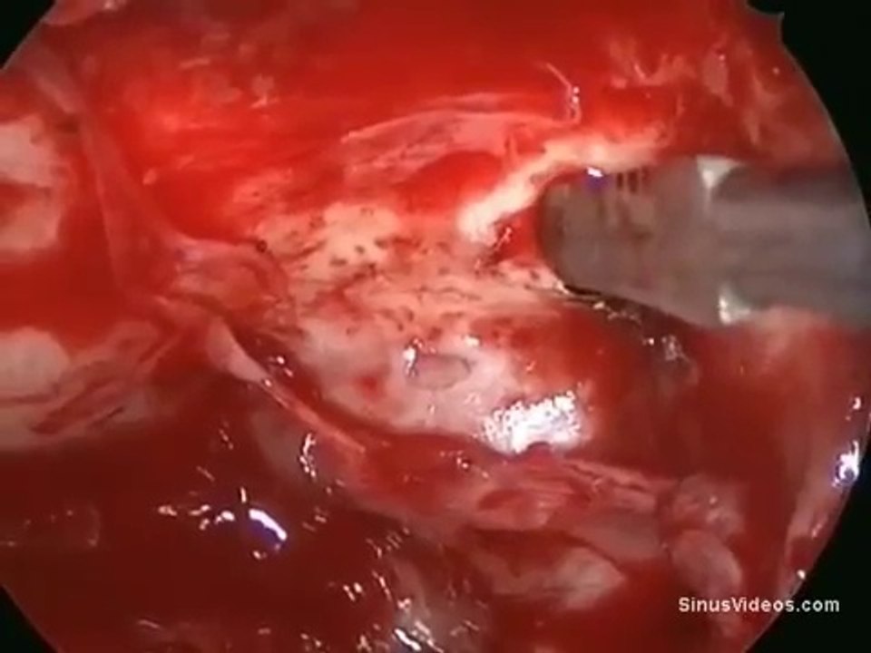 Optic nerve decompression under endoscopic
