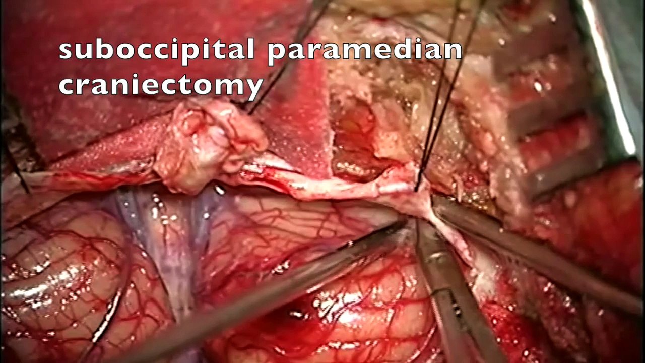 pineal region meningioma sitting position infratentorial supracerebellar