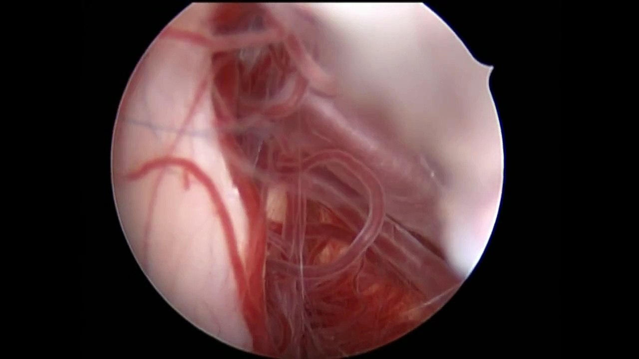Pineal region tumor presenting with hydrocephalus and gaze palsy