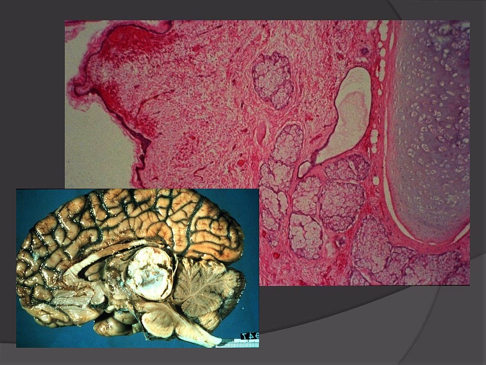 Neurosurgery