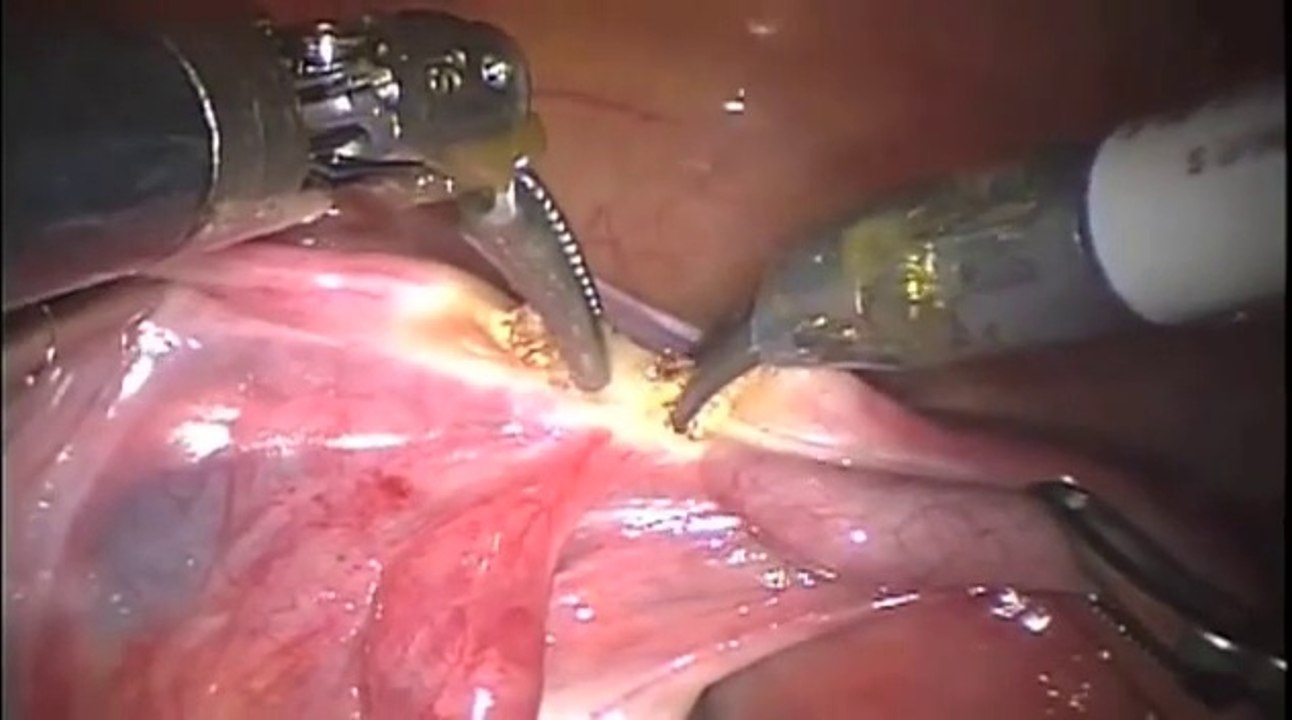 DaVinci Robotic Hysterectomy by Dr. William Cody