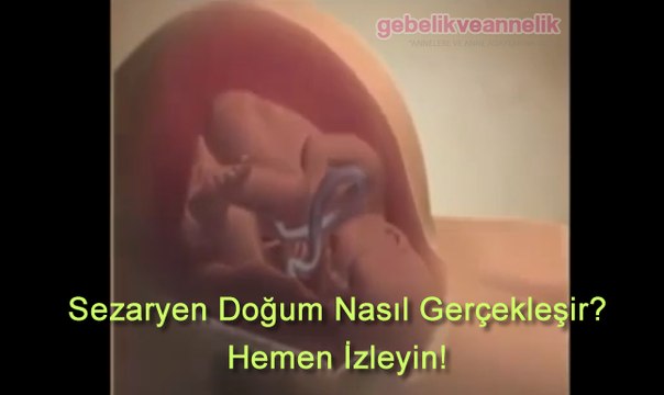 Sezaryen Doğum Videosu İzle - Sezaryenle Doğum Nasıl Olur?