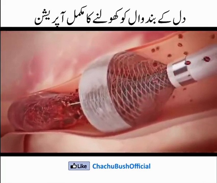 heart operation