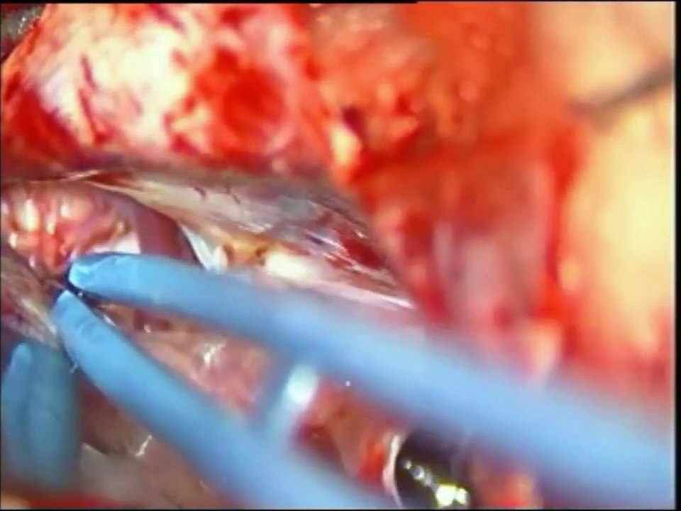 BRAIN TUMOR-EPIDERMOID-CEREBELLO PONTINE ANGLE.-microsurgery-dr suresh dugani/hubli/india
